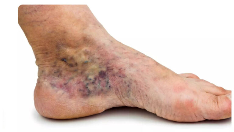 6 warning symptoms of Peripheral Artery Disease (PAD), as revealed by top vascular surgeon